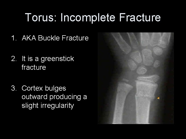 Torus: Incomplete Fracture 1. AKA Buckle Fracture 2. It is a greenstick fracture 3.