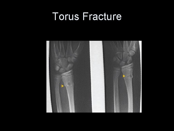 Torus Fracture 