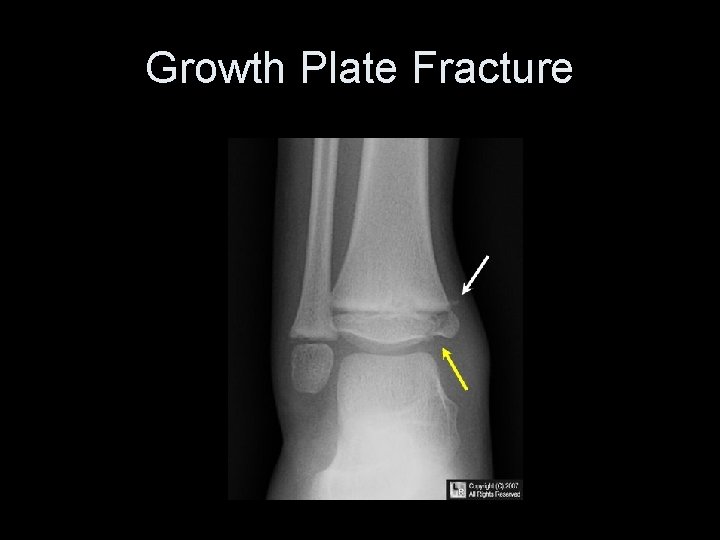 Growth Plate Fracture 