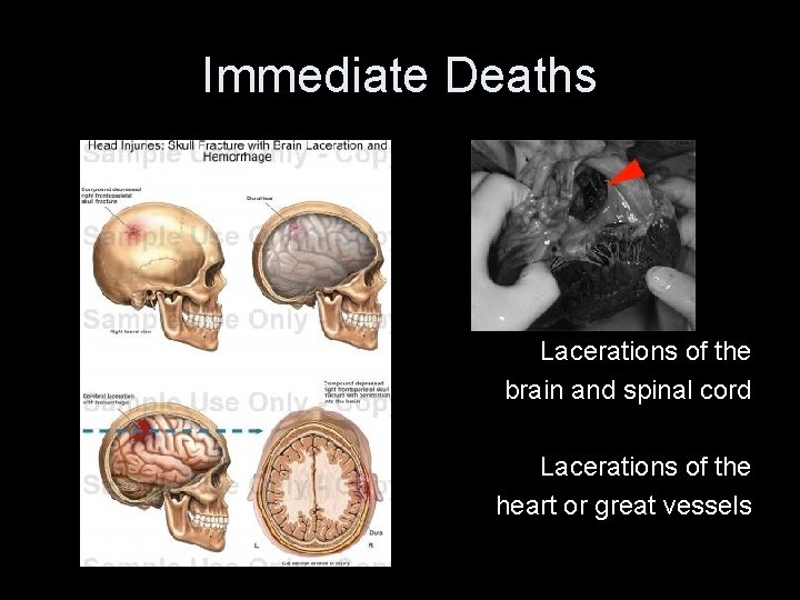 Immediate Deaths Lacerations of the brain and spinal cord Lacerations of the heart or