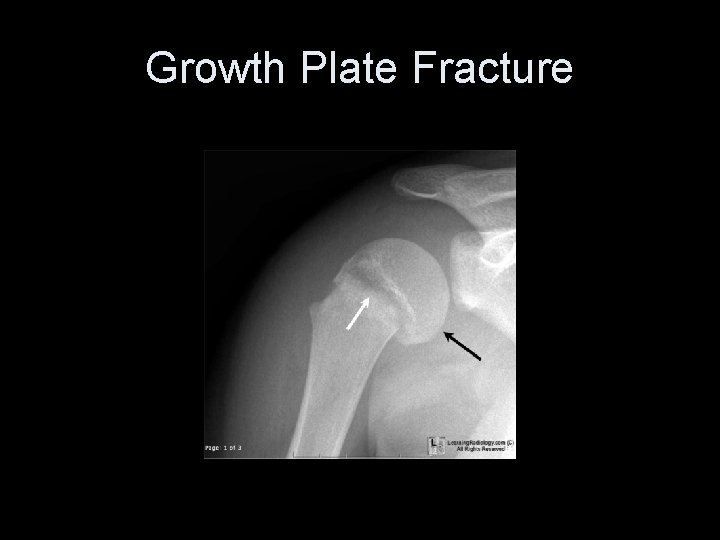 Growth Plate Fracture 