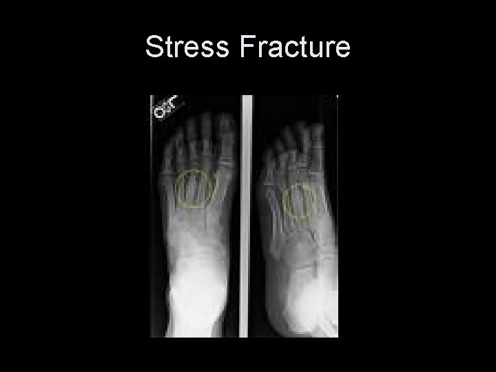 Stress Fracture 