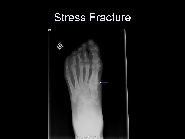 Stress Fracture 