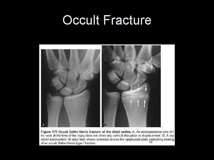 Occult Fracture 