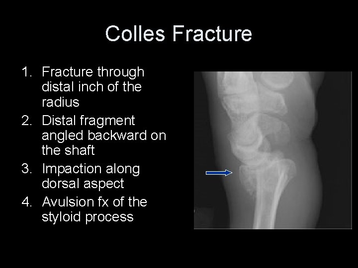 Colles Fracture 1. Fracture through distal inch of the radius 2. Distal fragment angled