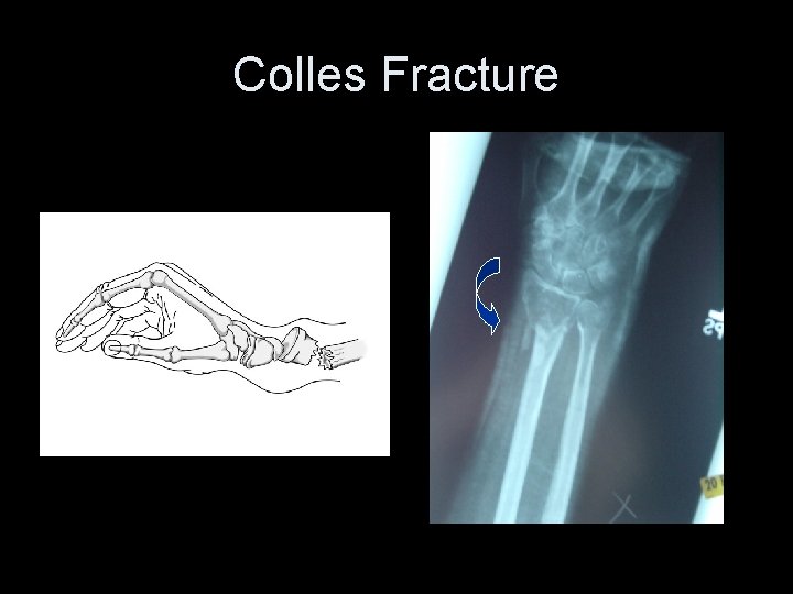 Colles Fracture 