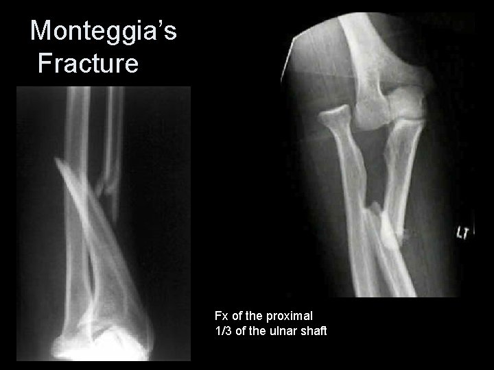 Monteggia’s Fracture Fx of the proximal 1/3 of the ulnar shaft 