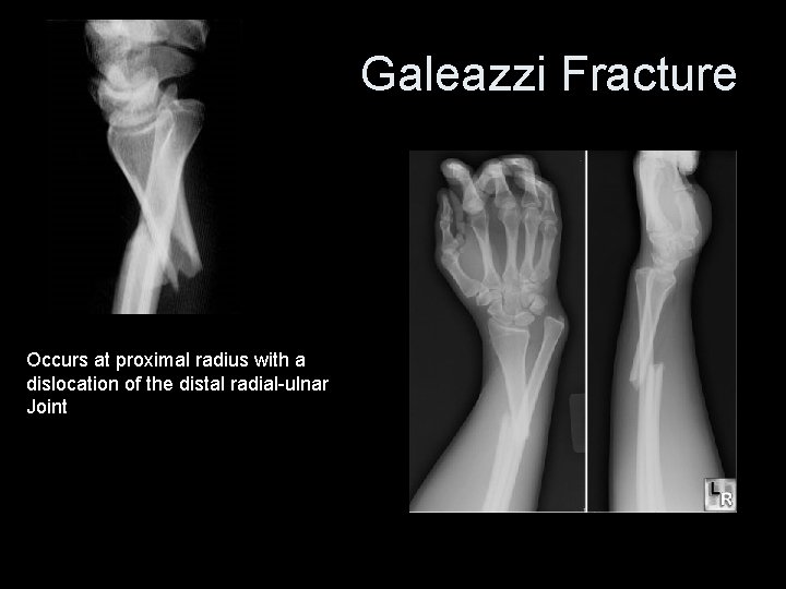 Galeazzi Fracture Occurs at proximal radius with a dislocation of the distal radial-ulnar Joint