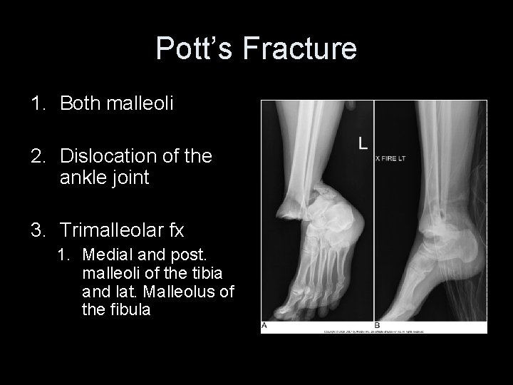 Pott’s Fracture 1. Both malleoli 2. Dislocation of the ankle joint 3. Trimalleolar fx