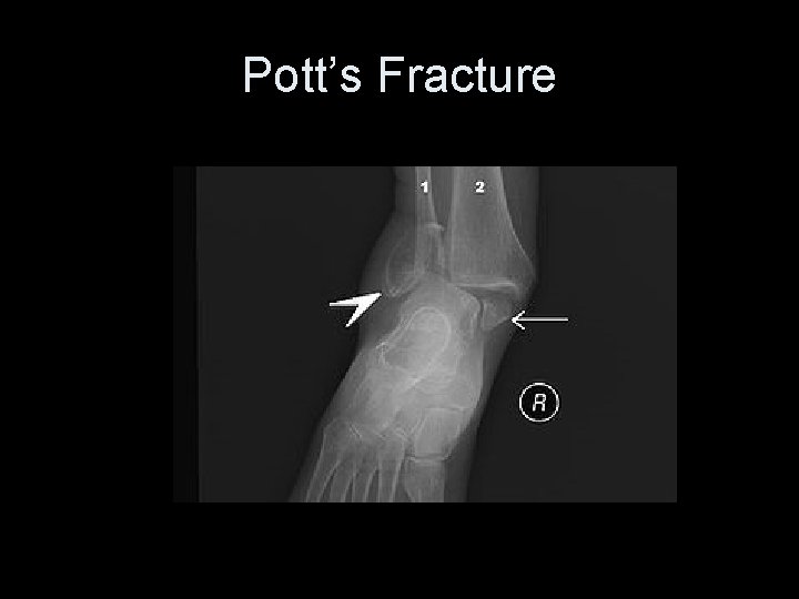 Pott’s Fracture 