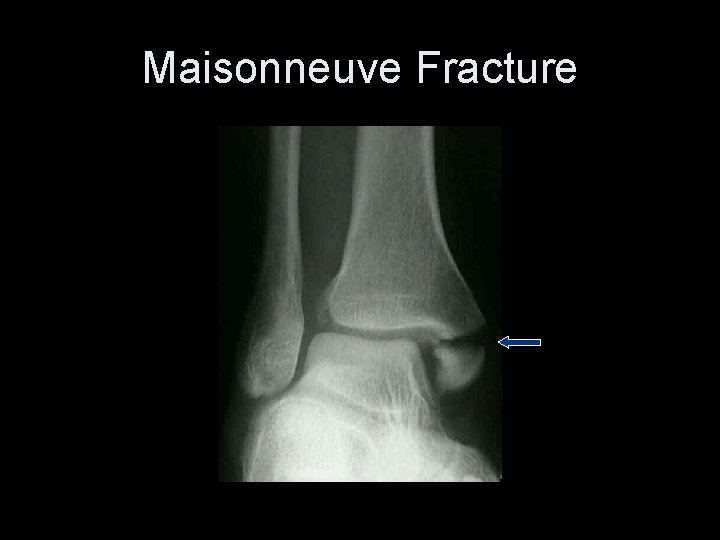 Maisonneuve Fracture 