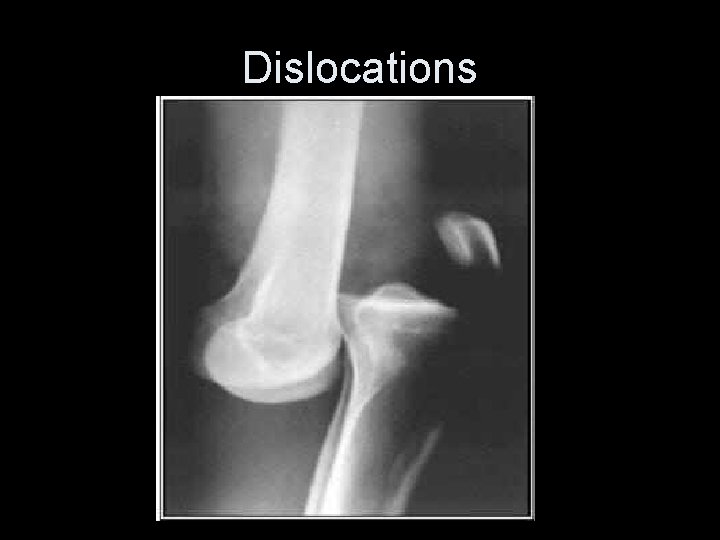 Dislocations 