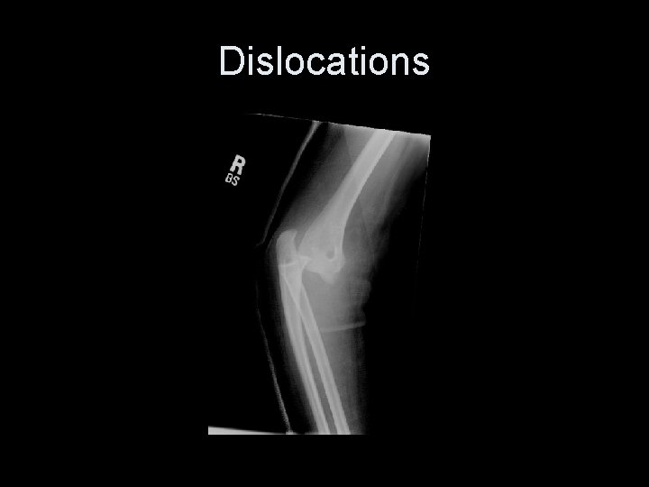 Dislocations 