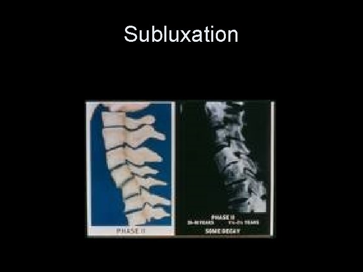 Subluxation 