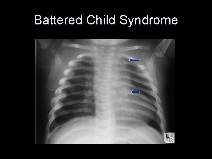 Battered Child Syndrome 