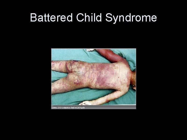 Battered Child Syndrome 