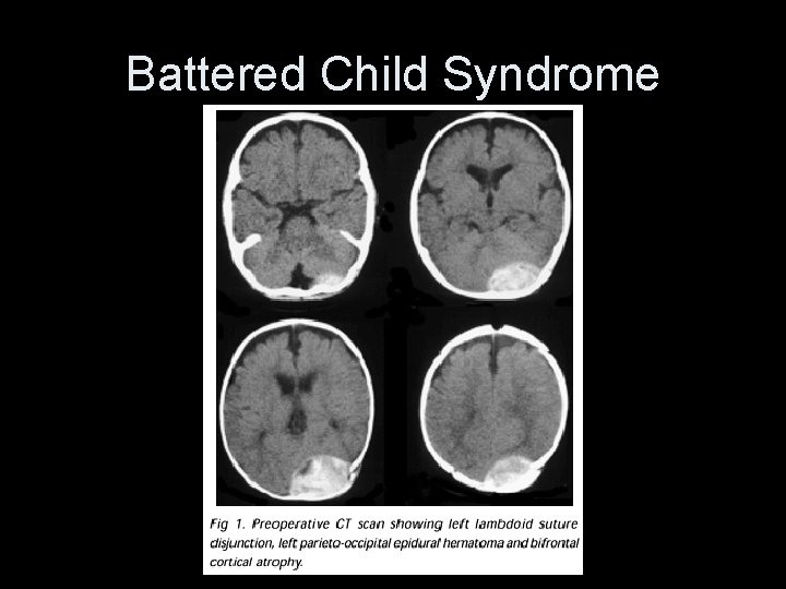 Battered Child Syndrome 