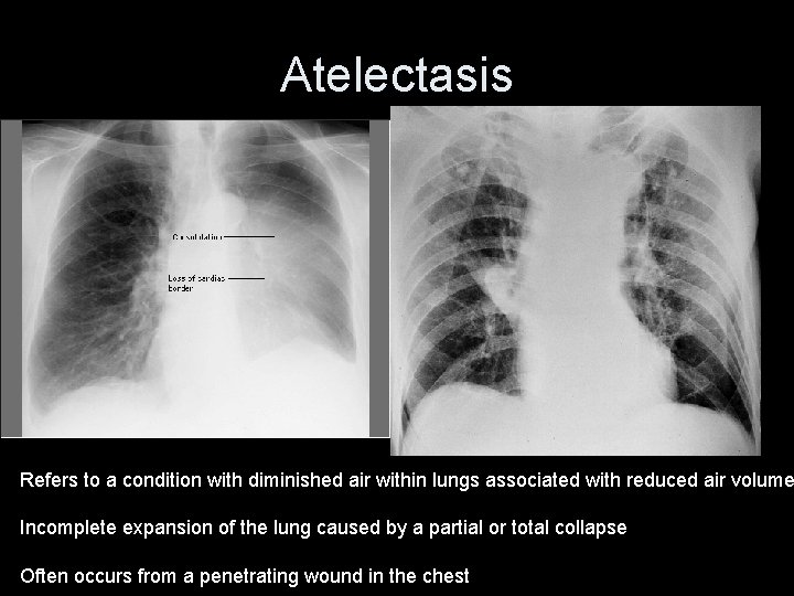 Atelectasis Refers to a condition with diminished air within lungs associated with reduced air