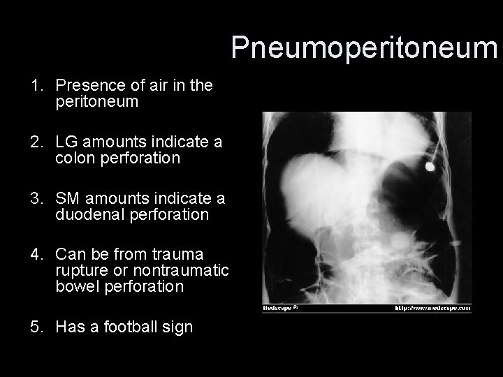 Pneumoperitoneum 1. Presence of air in the peritoneum 2. LG amounts indicate a colon