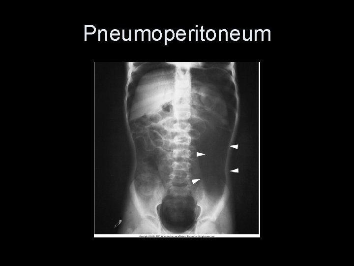 Pneumoperitoneum 