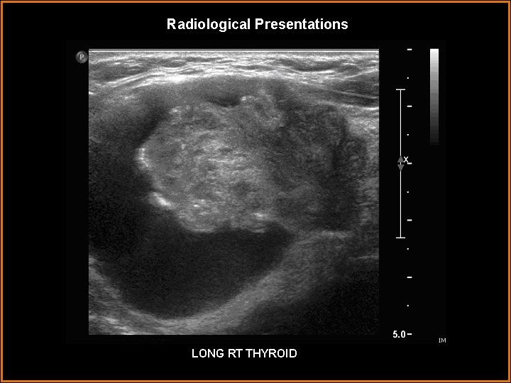 Radiological Presentations LONG RT THYROID 