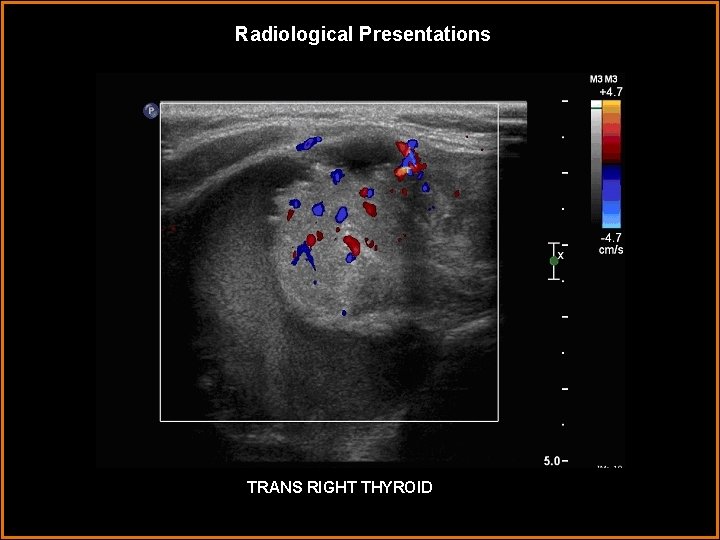 Radiological Presentations TRANS RIGHT THYROID 