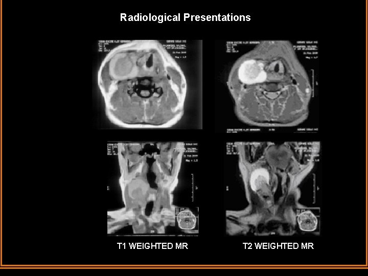 Radiological Presentations T 1 WEIGHTED MR T 2 WEIGHTED MR 