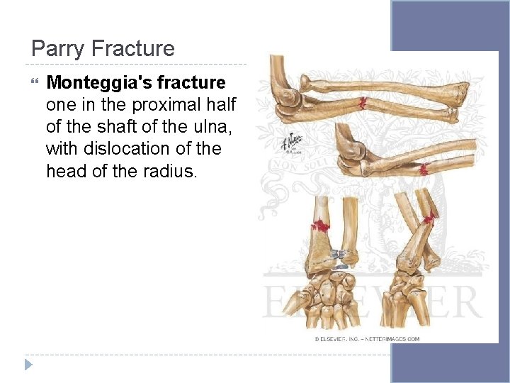 Parry Fracture Monteggia's fracture one in the proximal half of the shaft of the