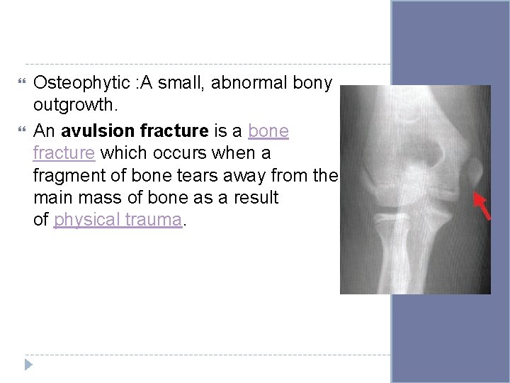  Osteophytic : A small, abnormal bony outgrowth. An avulsion fracture is a bone