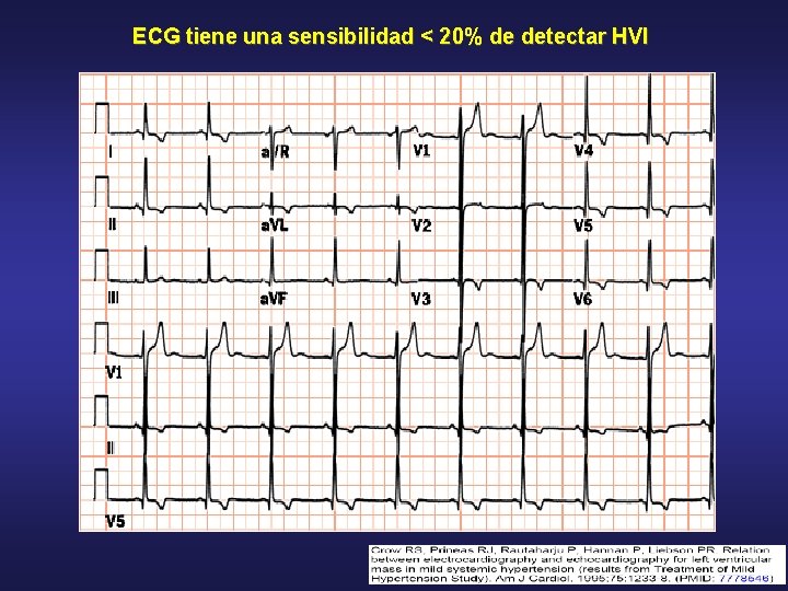 ECG tiene una sensibilidad < 20% de detectar HVI 