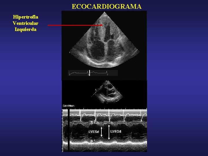 ECOCARDIOGRAMA Hipertrofia Ventricular Izquierda 