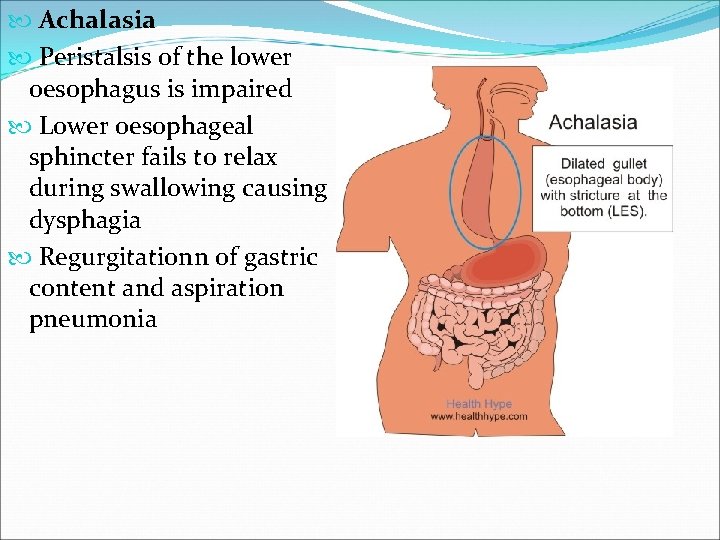 Achalasia Peristalsis of the lower oesophagus is impaired Lower oesophageal sphincter fails to