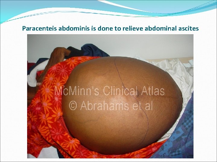 Paracenteis abdominis is done to relieve abdominal ascites 
