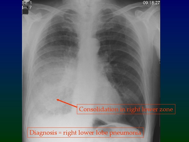 Consolidation in right lower zone Diagnosis = right lower lobe pneumonia 