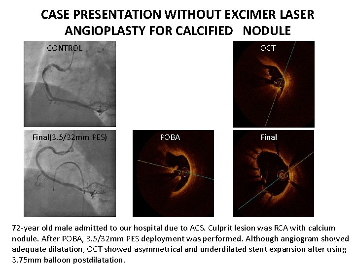 CASE PRESENTATION WITHOUT EXCIMER LASER ANGIOPLASTY FOR CALCIFIED　NODULE CONTROL Final(3. 5/32 mm PES) OCT