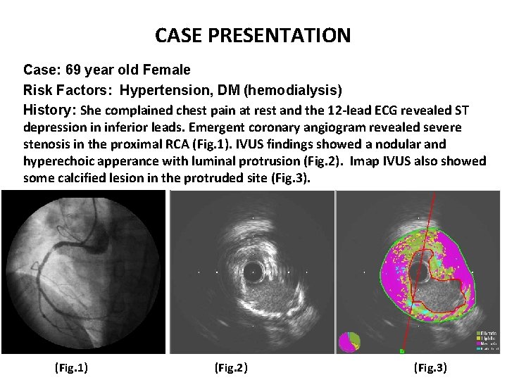 CASE PRESENTATION Case: 69 year old Female Risk Factors: Hypertension, DM (hemodialysis) History: She