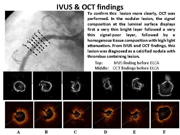 IVUS & OCT findings A A C B E D To confirm this　lesion more