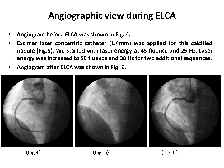 Angiographic view during ELCA • Angiogram before ELCA was shown in Fig. 4. •