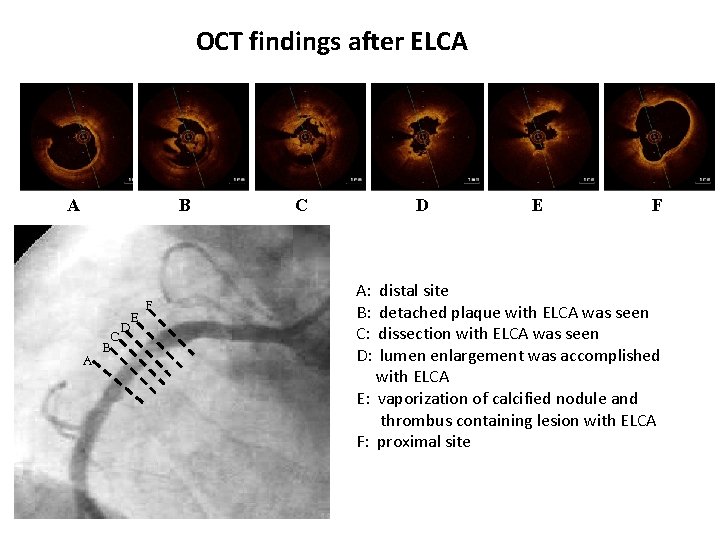 OCT findings after ELCA A B A C B E D F C D