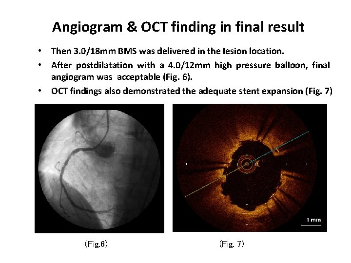 Angiogram & OCT finding in final result • Then 3. 0/18 mm BMS was