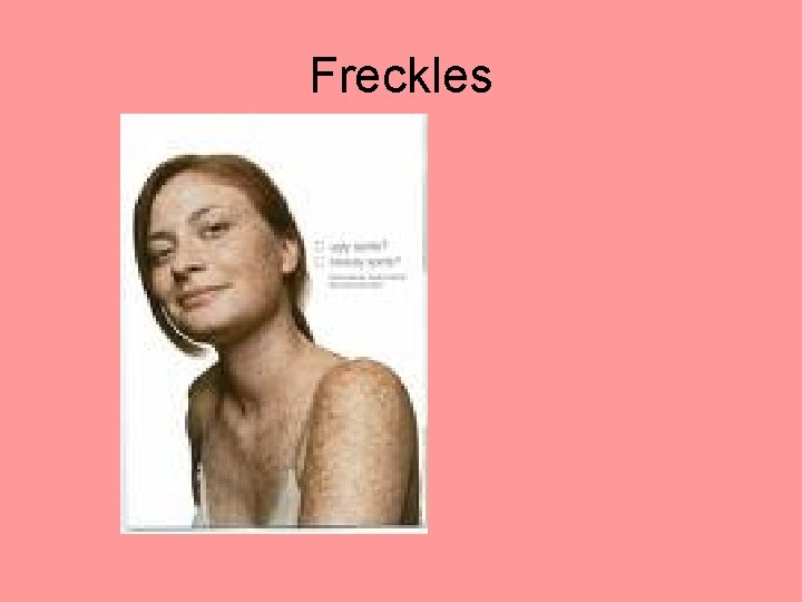 Freckles 