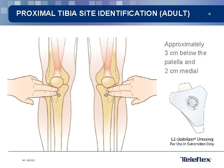 PROXIMAL TIBIA SITE IDENTIFICATION (ADULT) Approximately 3 cm below the patella and 2 cm