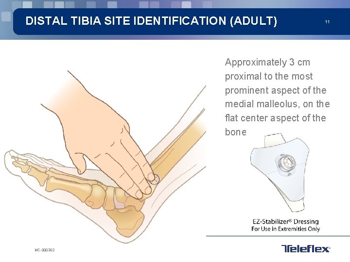DISTAL TIBIA SITE IDENTIFICATION (ADULT) 11 Approximately 3 cm proximal to the most prominent