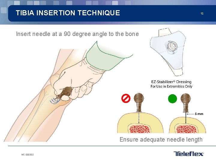 TIBIA INSERTION TECHNIQUE 12 Insert needle at a 90 degree angle to the bone