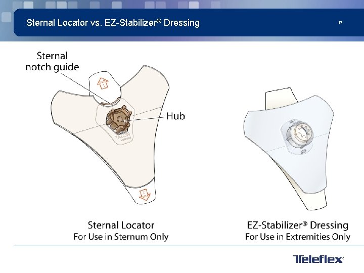 Sternal Locator vs. EZ-Stabilizer® Dressing 17 