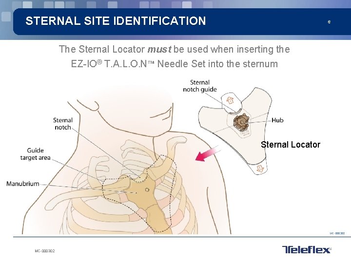 STERNAL SITE IDENTIFICATION 6 The Sternal Locator must be used when inserting the EZ-IO®