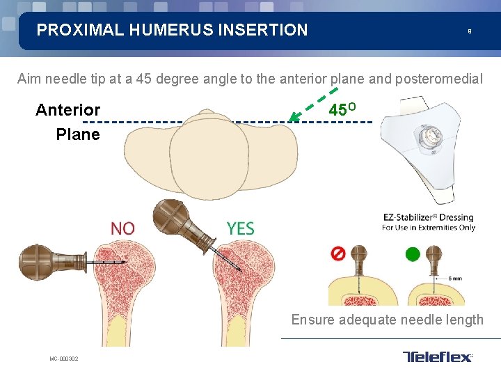 PROXIMAL HUMERUS INSERTION 9 Aim needle tip at a 45 degree angle to the