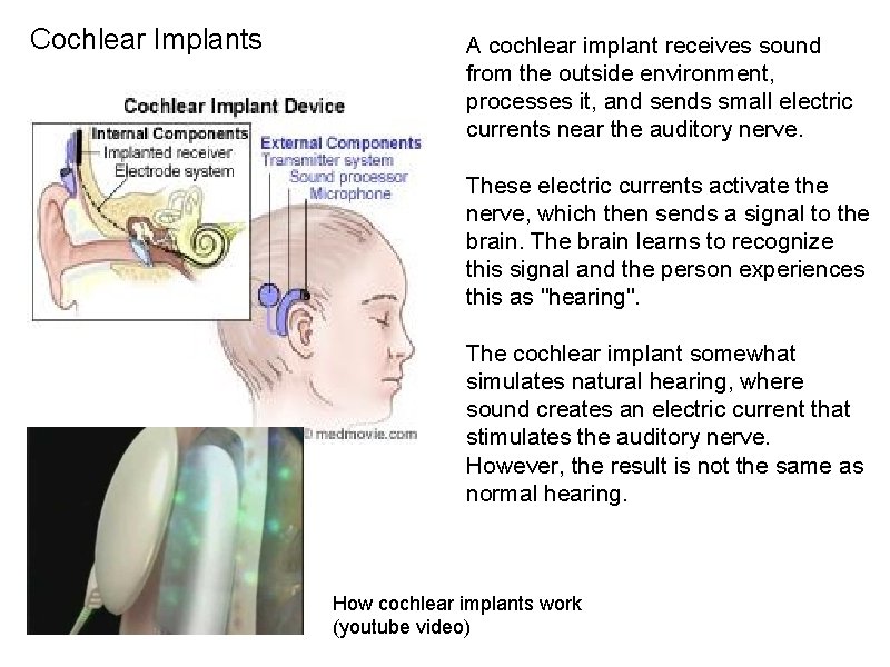 Cochlear Implants A cochlear implant receives sound from the outside environment, processes it, and