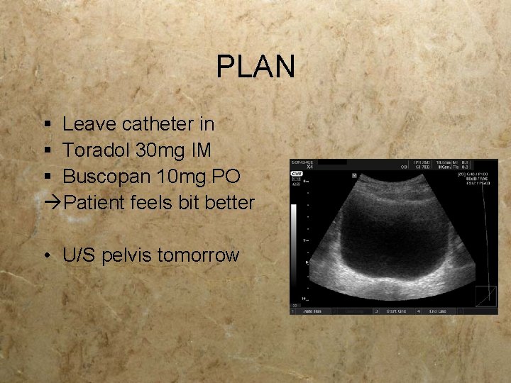 PLAN § Leave catheter in § Toradol 30 mg IM § Buscopan 10 mg PLAN § Leave catheter in § Toradol 30 mg IM § Buscopan 10 mg