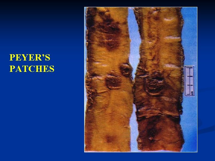 PEYER’S PATCHES 